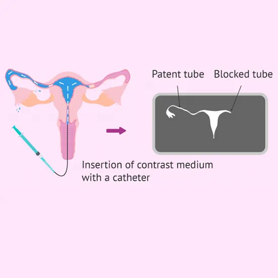 What is the Role of HSG Test in Infertility?